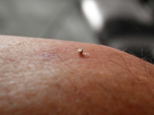 bijengiftherapie, elleboog